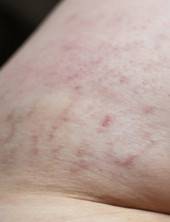 Doença de Cushing: diagnóstico e manejo 